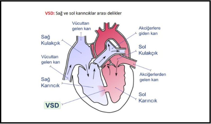 Doğuştan kalp hastalığı VSD: Belirtileri, riskleri ve tedavi süreci